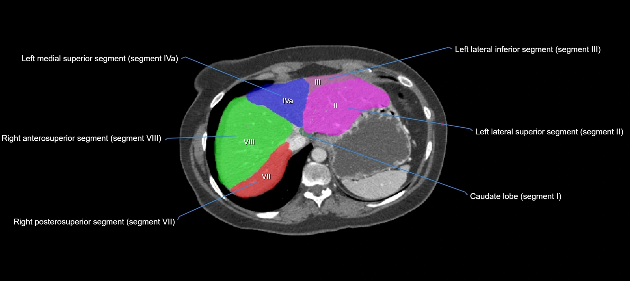 CT liver segments axial cross sectional anatomy labelled image-00064.webp